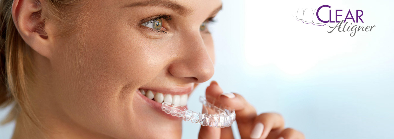 ClearALigner