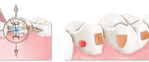 maestro3d.dental.studio.attachments
