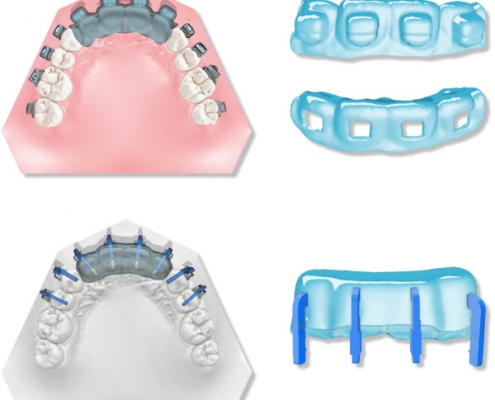 maestro3d.dental.studio.brackets.tray