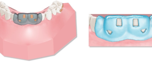 maestro3d.dental.studio.clear.aligner.etching.guide