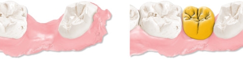 maestro3d.dental.studio.virtual.pontic پونتیک مجازی