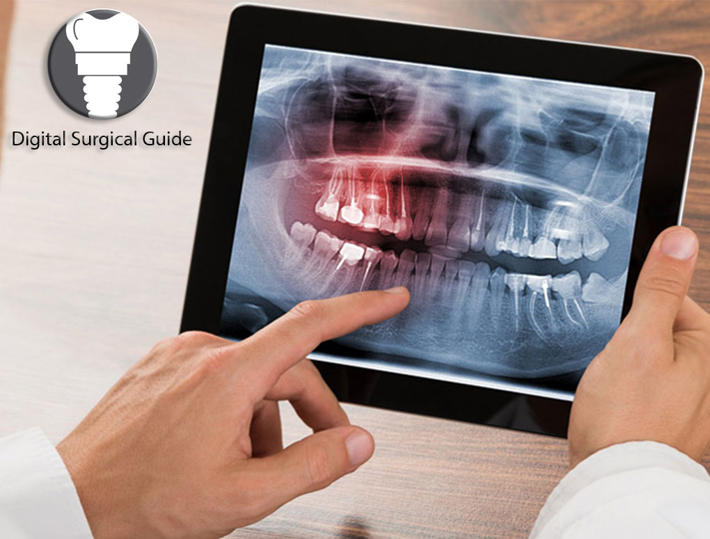 SurgicalGuide