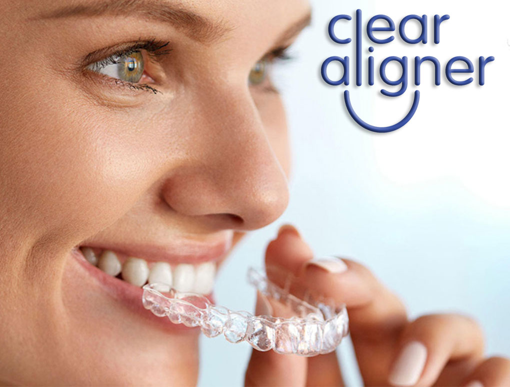 clearnaligner